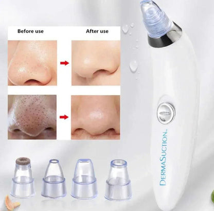 4-in-1 Face Derma Suction Device - Portable Blackhead & Pore Vacuum Cleaner (Battery Operated) - Homnix.pk